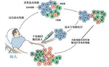干细胞移植治疗