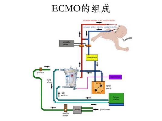 体外膜肺氧合