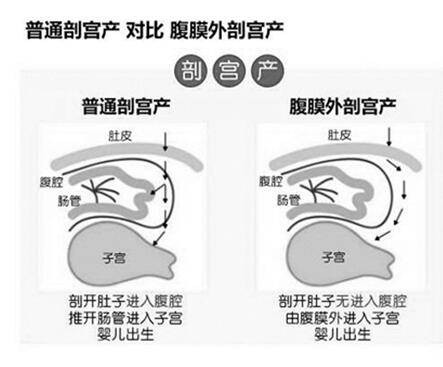 腹膜外剖宫产术（手术）