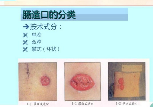 造口