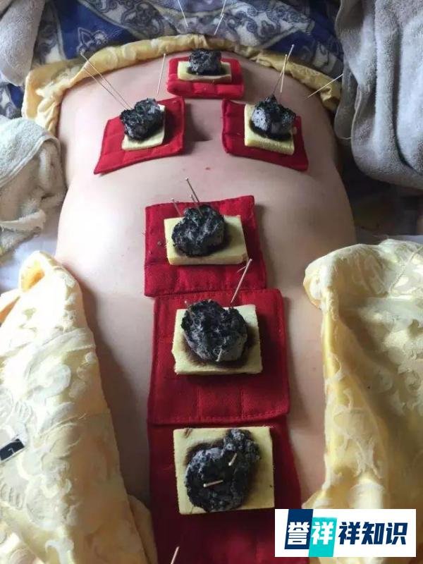 艾灸后死亡