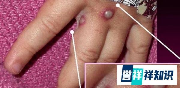 超100例确诊或疑似猴痘病例,在多国爆发,会是新的疫情爆发吗?