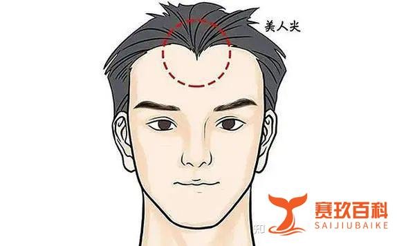 什么是“美人尖”?哪些人不适合做植发手术美人尖?