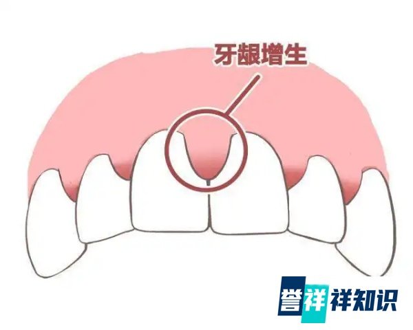想在成都做种植,种植牙和烤瓷牙哪个好一点?种植牙有什么弊端吗,时间久了会不会出现什么问题?