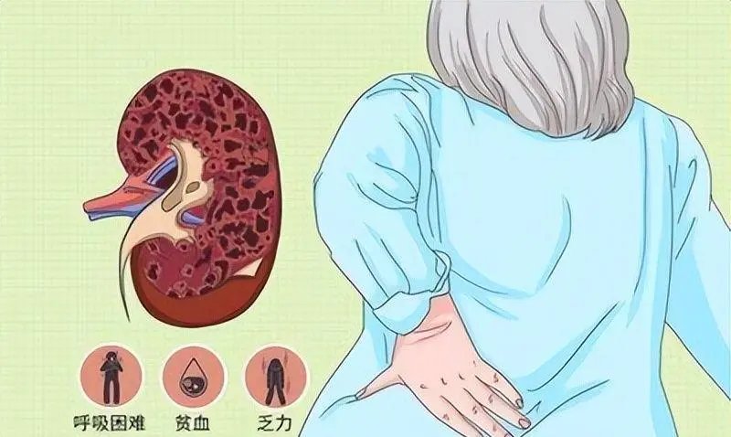 女子尿血1年取出20厘米蚯蚓状血丝:再晚治疗将危及生命!她的现状如何?