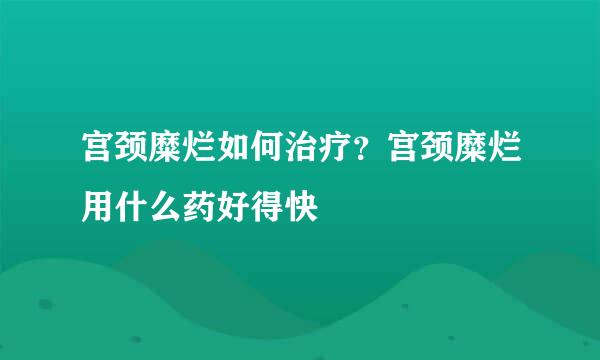 宫颈糜烂如何治疗?宫颈糜烂用什么药好得快